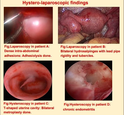 hystero-laparoscopic hystero-laparoscopic